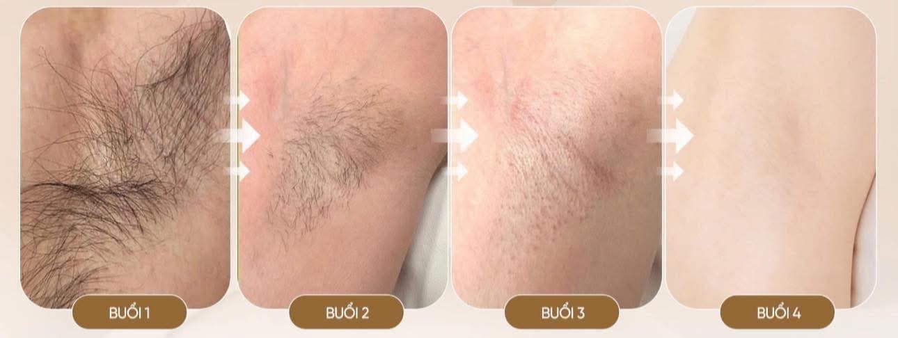Ni Spa cung cấp dịch vụ triệt lông, gội đầu dưỡng sinh, massage trị liệu, chăm sóc và phục hồi da tại Vinhome Grand Park, HCM. - 1/1